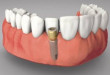 Tìm hiểu giá trồng răng implant hiện nay là bao nhiêu