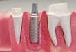 Hỏi – Đáp: Cấy ghép răng Implant giá bao nhiêu?
