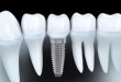 Địa chỉ ghép răng Implant ở Hà Nội