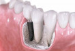 Bài thuốc chữa sâu răng hiệu quả trong tích tắc