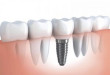 Chuyên gia giải đáp thắc mắc cho bạn: Trồng răng implant là gì?