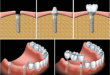 Kỹ thuật cấy ghép răng implant hiện đại cho kết quả ưu việt