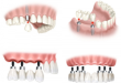Làm răng Implant ở đâu an toàn tại Hà Nội?