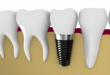 Giá làm răng sứ implant bao nhiêu tiền hiện nay?