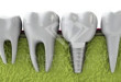 Người mất răng nên làm cầu răng hay Implant thì tốt hơn?