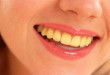 3 nguyên nhân làm răng ố vàng nhiều người mắc phải