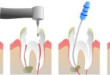 Điều trị tủy răng như thế nào? – Chuyên gia Nha khoa
