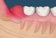 Răng khôn mọc ngầm có nên nhổ không? – Những lưu ý quan trọng.