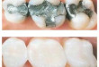 Hàn răng sâu có đau không? Bác sĩ nha khoa tư vấn