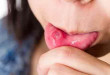 Lở miệng kéo dài bao lâu thì khỏi? Kiến thức nha khoa