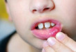 Nguyên nhân gây bệnh lở miệng ở trẻ em – Phụ huynh cần biết