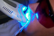 Khoa học y khoa phân tích “Tẩy trắng răng bằng đèn plasma có hại không?”