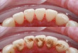 Lấy cao răng có ảnh hưởng gì không? >>> Nghiên cứu nha khoa