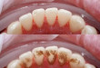 Hot “Quy trình lấy cao răng như thế nào” mới là chuẩn quốc tế?