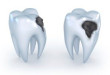 Qúa trình diễn ra của bệnh viêm tủy răng