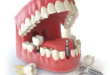 Trồng răng implant có tốt không? – Yếu tố nào ảnh hưởng?