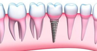 Cắm răng Implant ở đâu uy tín – Chất lượng tốt, bảo hành dài hạn