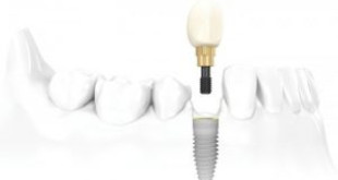 Làm răng Implant ở đâu an toàn tại Hà Nội?