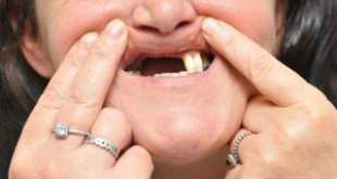 Trồng răng implant có đau không? Chuyên gia tư vấn