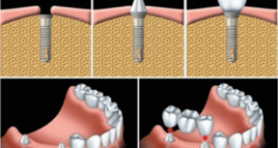 Kỹ thuật cấy ghép răng implant hiện đại cho kết quả ưu việt