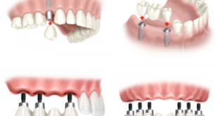 Trồng răng implant có nguy hiểm không? – Lý giải của chuyên gia