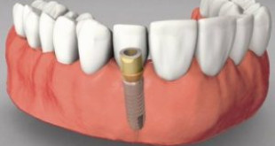 Giá làm răng sứ implant bao nhiêu tiền hiện nay?