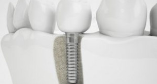 Cấy ghép răng sứ Implant và công nghệ hoàn hảo cho phục hình răng mất