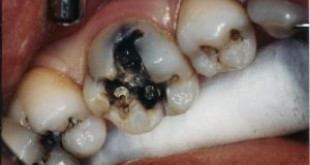 Hỏi đáp cùng chuyên gia: Răng hàm sâu có nên nhổ?