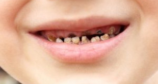 Kiến thức về sâu răng ở trẻ em và cách phòng ngừa