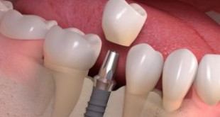 Cập nhật bảng giá răng Implant đầy đủ & mới nhất 2018
