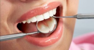 Lấy cao răng để làm gì? Lời khuyên của bác sĩ nha khoa