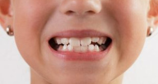 Cùng nghe lời khuyên từ chuyên gia cách chữa trị nghiến răng hiệu quả nhé?