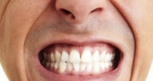 Cách điều trị bệnh nghiến răng hiệu quả nhanh chóng