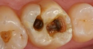 Bài thuốc chữa sâu răng hiệu quả trong tích tắc