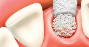 Những thông tin cần biết rõ về phương pháp cấy ghép xương răng