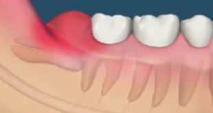 Răng khôn mọc ngầm có nên nhổ không? – Những lưu ý quan trọng.