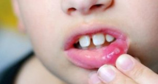 Nguyên nhân gây bệnh lở miệng ở trẻ em – Phụ huynh cần biết