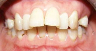 Răng hô là gì? Cách nhận biết răng hô chuẩn không cần chỉnh