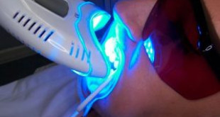 Khoa học y khoa phân tích “Tẩy trắng răng bằng đèn plasma có hại không?”