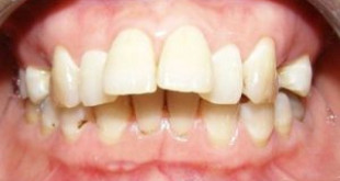 Nguyên nhân gây răng vẩu phổ biến không phải ai cũng biết