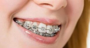Bạn từng thắc mắc “Hô hàm có niềng răng được không?” >>> Xem ngay