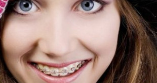 “HOT” Chia sẻ sự thật cho bạn biết có nên niềng răng không?