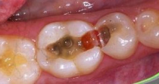 Sâu răng có chữa được không theo phân tích của chuyên gia nha khoa