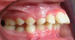 Bạn sẽ không biết răng hô có di truyền không nếu bỏ qua bài này