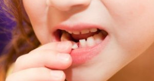 Cách khắc phục khi răng cửa bị lung lay hiệu quả nhất >>> Xem ngay