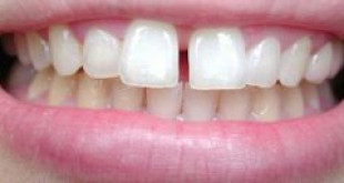 Phương pháp điều trị răng thưa bằng dịch vụ thẩm mỹ