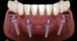Cấy ghép implant khi mất hết răng có được không? Bác sĩ tư vấn