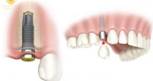 Sự thật cấy ghép implant sau khi nhổ răng có được không?