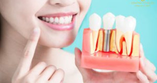 Cấy ghép răng sứ implant – Mọi nỗi lo về mất răng đều được giải quyết
