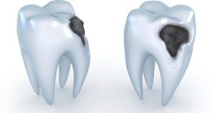 Qúa trình diễn ra của bệnh viêm tủy răng